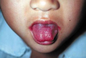 苺舌の症状を、NIID 国立感染症研究所のWebサイトから引用して例示しています。